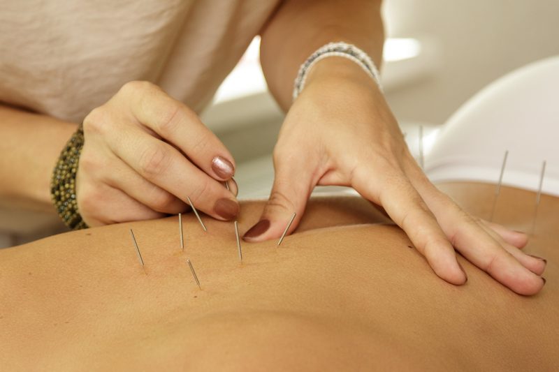 Acupuncturist placing needles along a patient's back during a digestive health treatment