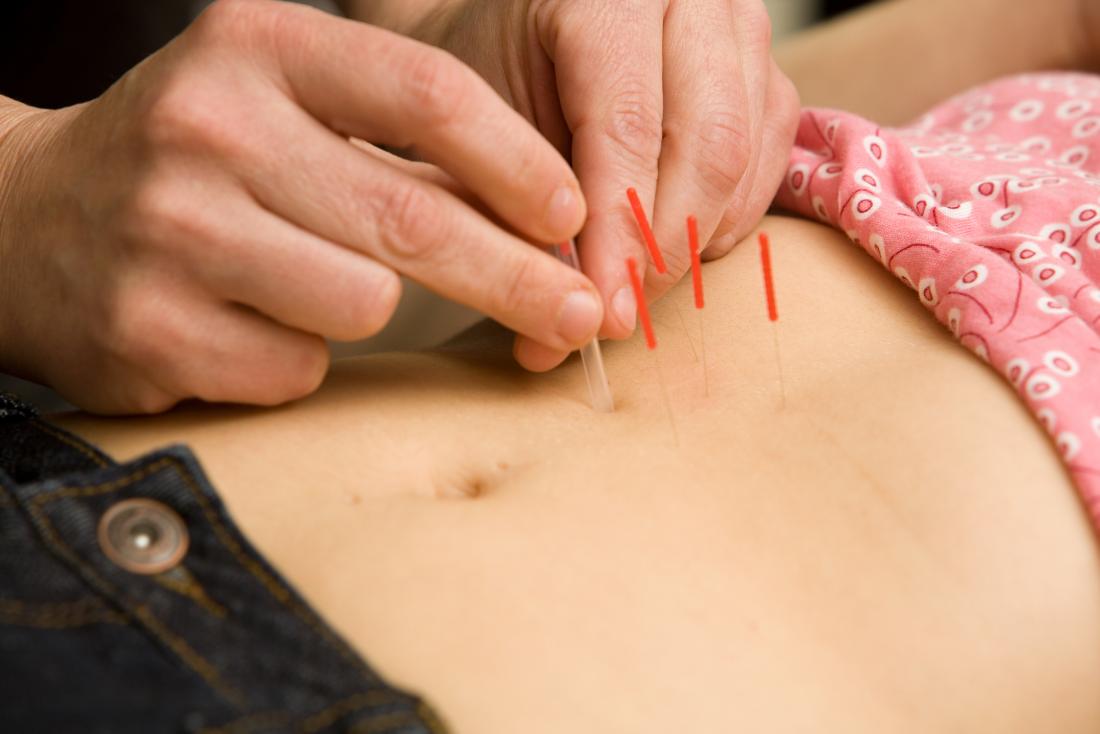 Fertility acupuncture